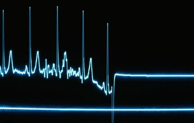 사망자에 발생하는 '죽었다 다시 살아나는' 라자루스 증후군 새 유형 The Lazarus Syndrome in Extremis?