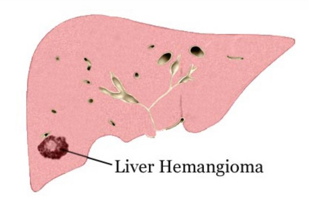간 혈관종