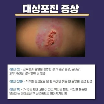 대상포진 치료방법에 대한 총정리 건강 질병관리_12