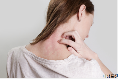 대상포진 예방접종 가격(최저가 확인, 무료접종 대상)과 관련하여 대상포진 발병하여 포진이 생긴 사람 사진