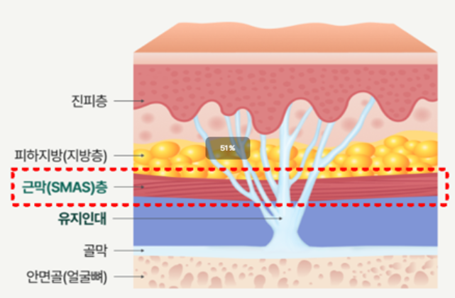 팔자주름 구조