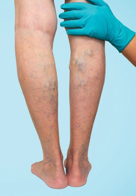 하지 정맥류 초기증상과 베나실 발거술 등의 치료방법 장단점