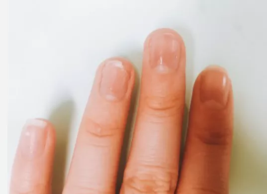 콜라겐의-효능-콜라겐-부작용-건강