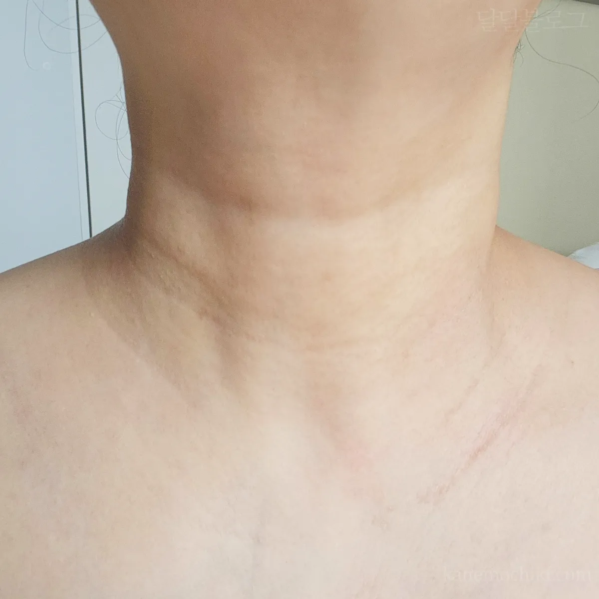 편평사마귀-제거4개월