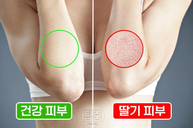 콜라겐 결핍증 부족증상 딸기피부