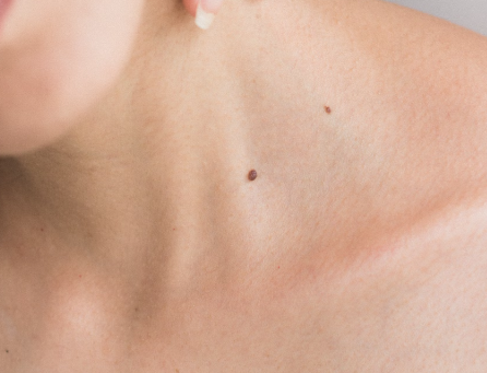 글루타치온 효능 : 피부