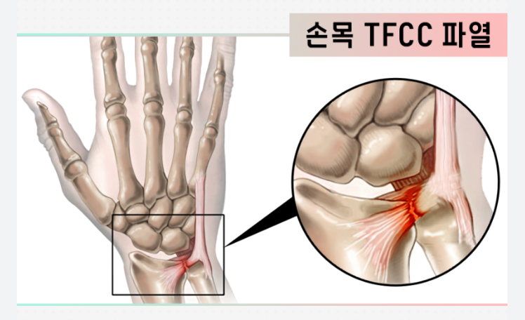 TFCC파열