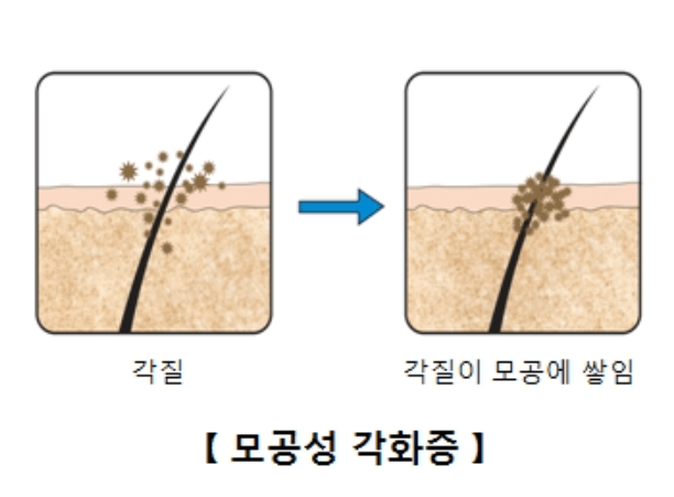 모공각화증
