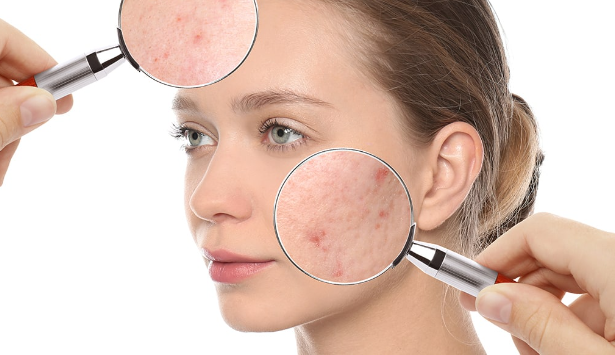 피부 트러블 대처 방법