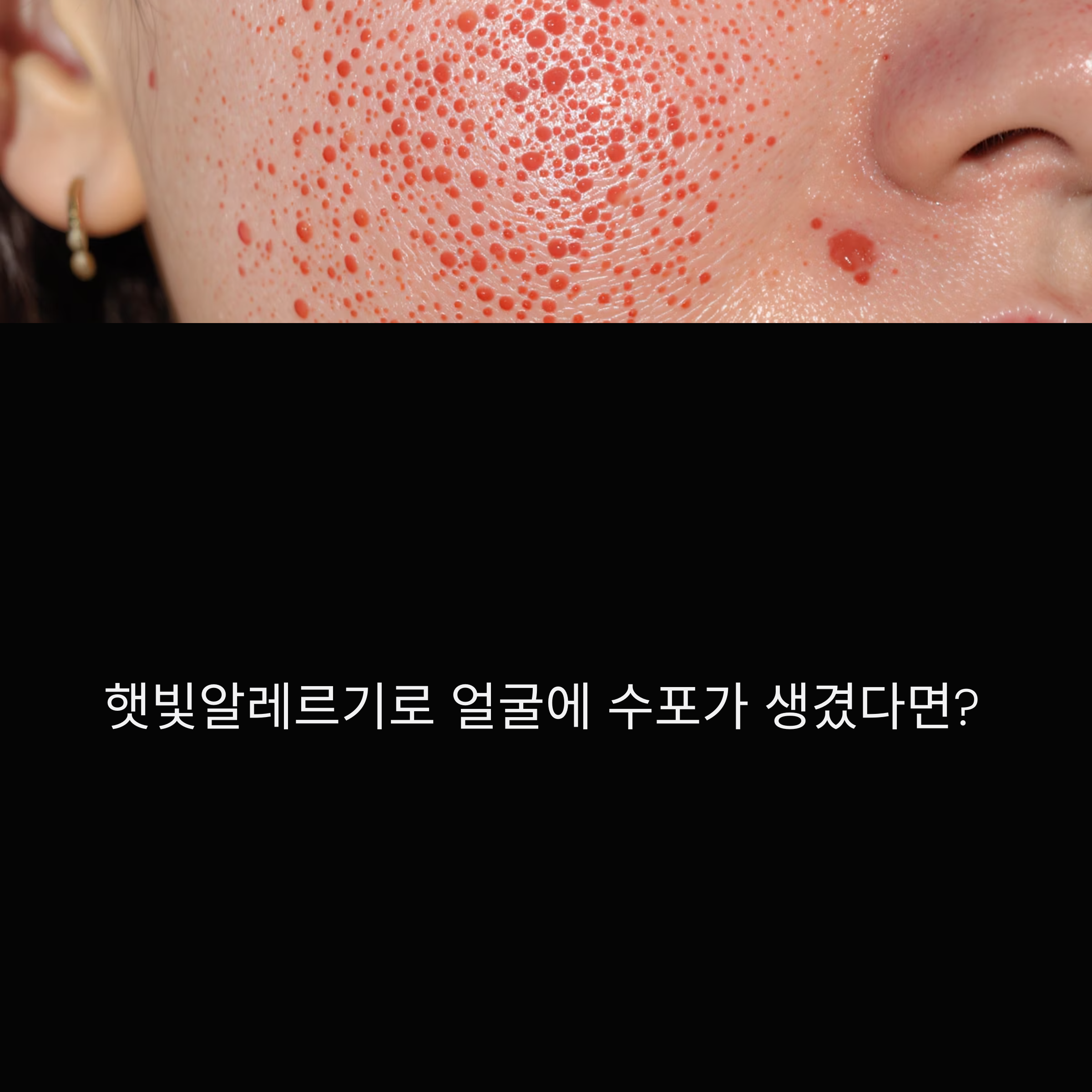 햇빛알레르기로 얼굴에 수포가 생겼다면 대처법은?