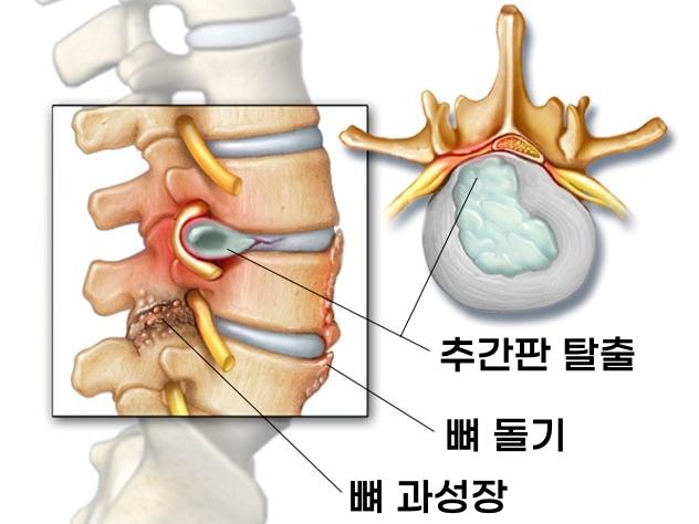 허리가 찌릿 아플때 척추관협착증 증상 원인 뼈 돌기