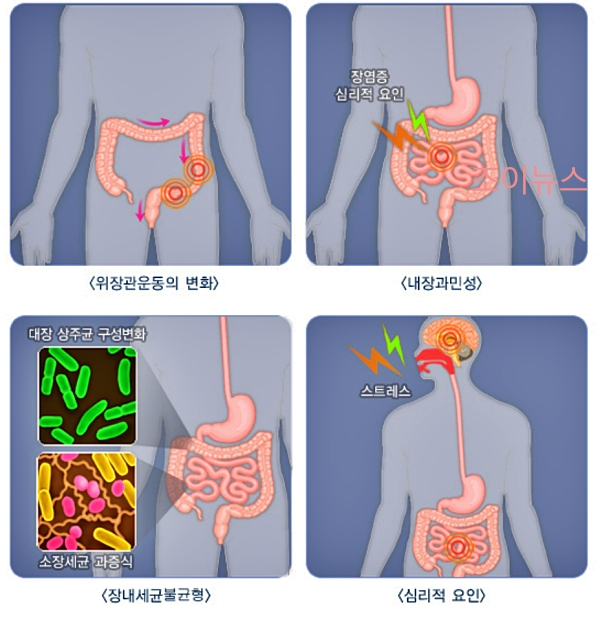 과민성대장증후군 발생 요인_출처:국가건강정보포털