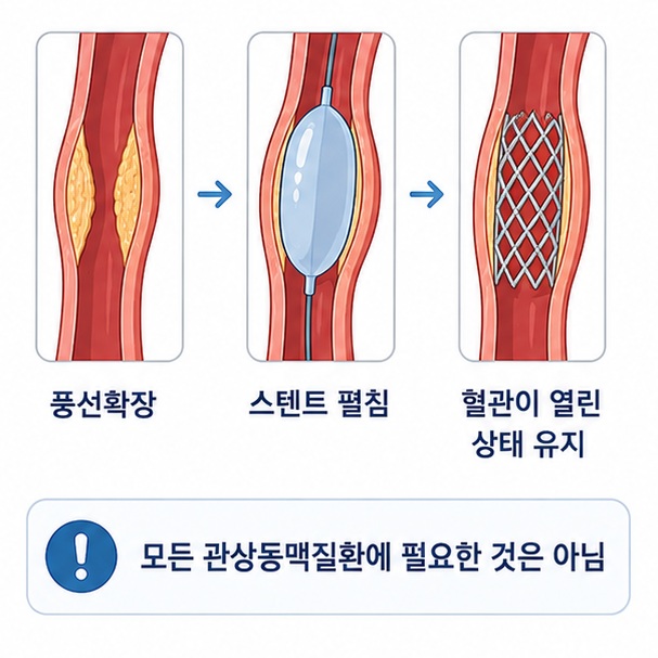 좁아진 혈관을 풍선으로 확장한 뒤 금속망 형태의 스텐트를 펼쳐 혈관이 열린 상태를 유지하도록 하는 원리를 보여 주는 그림