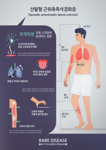그래픽 이미지_산발형 근위축측삭경화증(루게릭병)