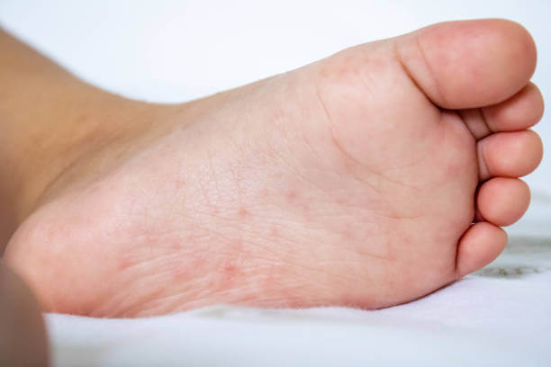 수족구 증상, 전염 및 잠복기와 예방까지! 수족구에 잠복기가 생기는 이유까지 알아봤습니다.