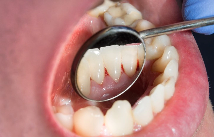 치은염 증상 8가지