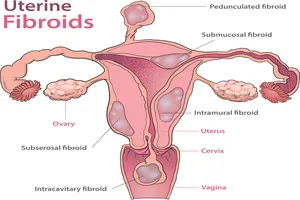 자궁근종-수술-입원기간