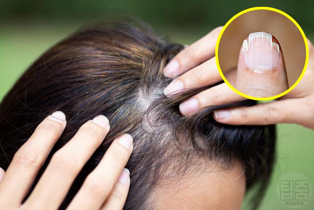 철분 결핍 증상 탈모 손톱갈라짐