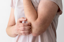 콜린성 두드러기 증상 치료