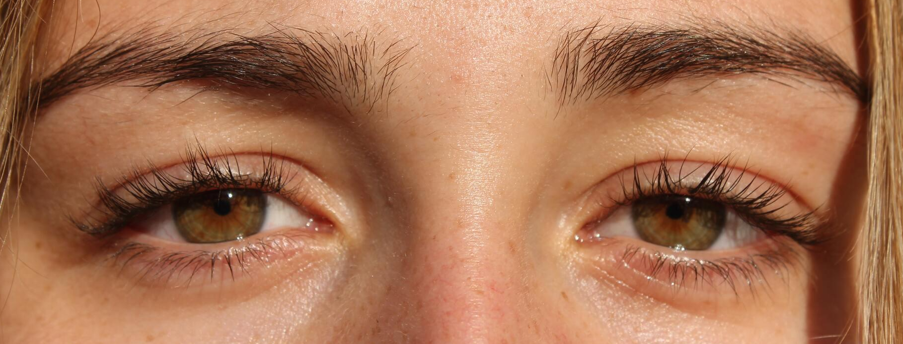 안검하수 수술비용과 수술방법 및 효과