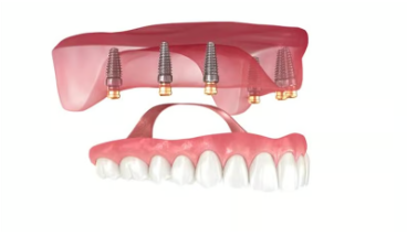 전체 임플란트 장점