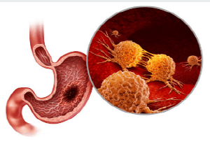 위암