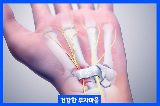 수근관이 좁아지면서 압력이 생기면 신경이 손상되면서 손목 통증이 발생