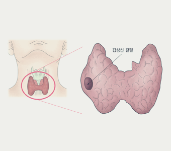 갑상선 기능 저하증 증상이 의심된다면?