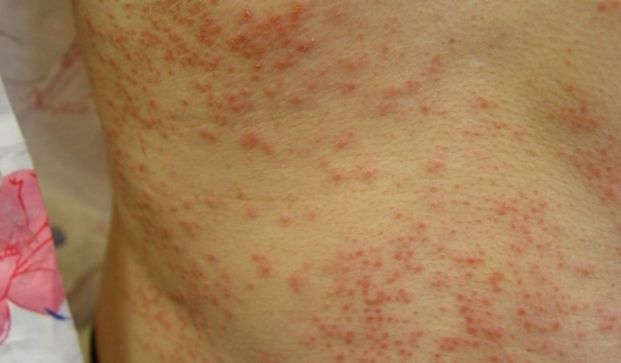 피부에 붉은 색의 반점과 가려움증이 수반되는 땀띠가 발생된 것을 확대를 하여 찍은 사진