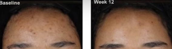 아클리프-크림으로-여드름-없애는-방법