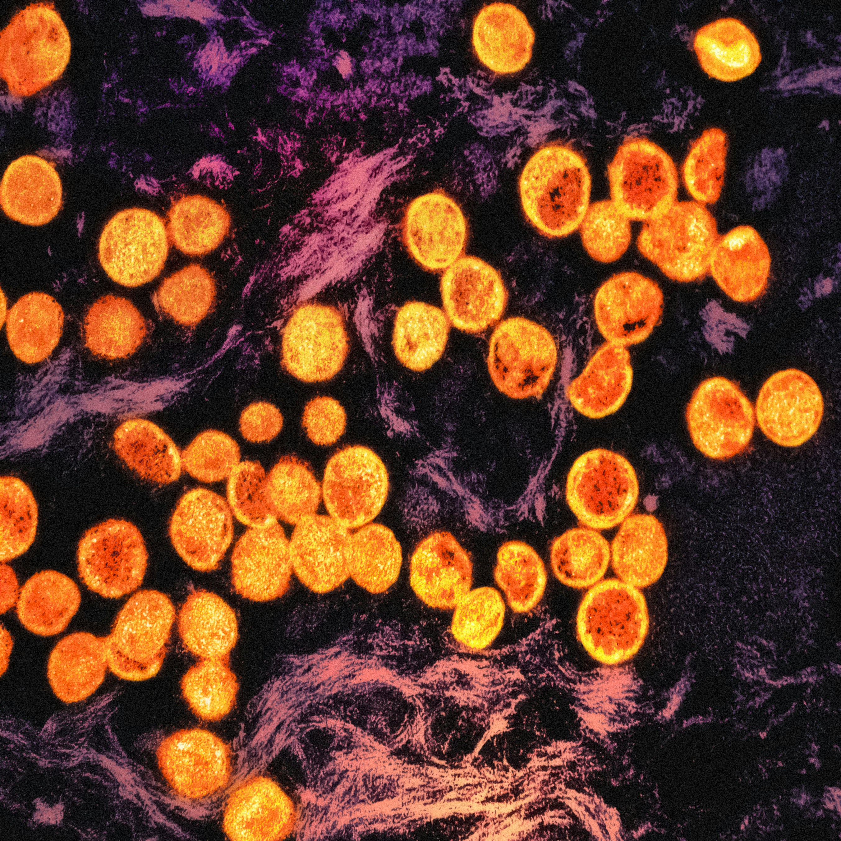 원숭이 두창 증상 및 감염경로 (+ 원인 백신 엠폭스)