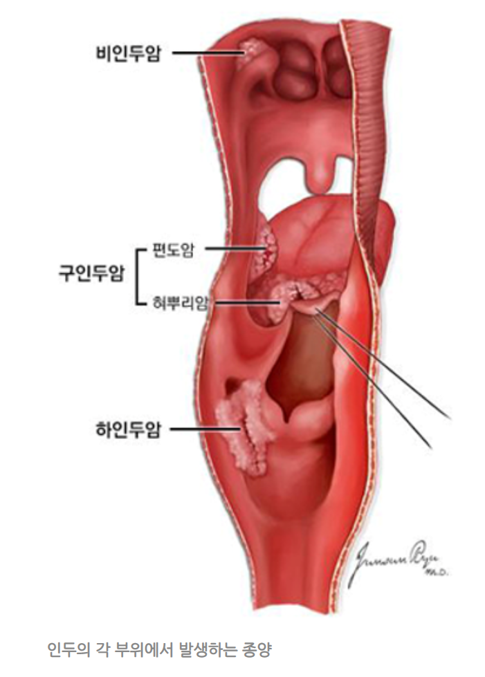후두암-편도암