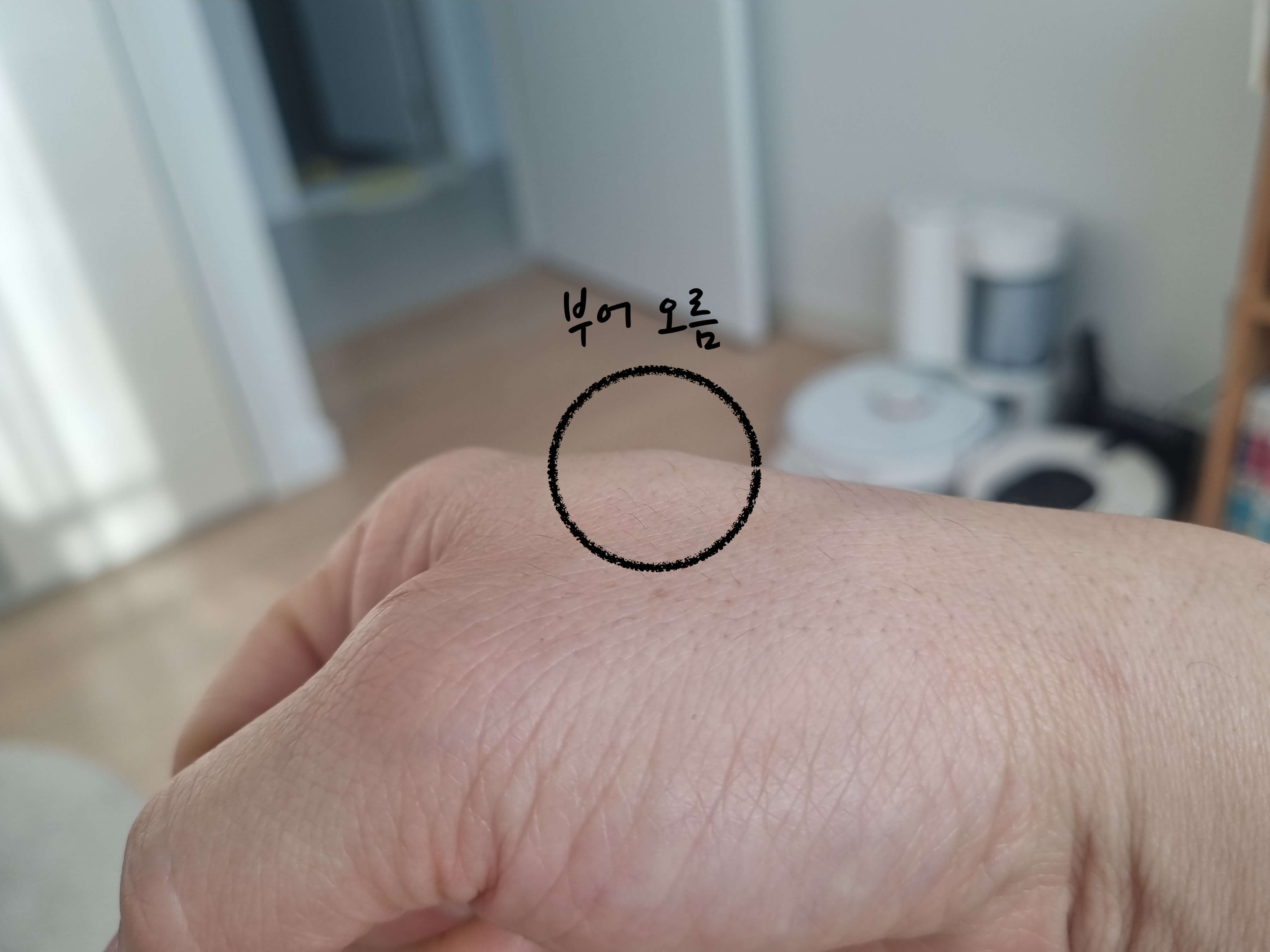 손등 결절종 위치