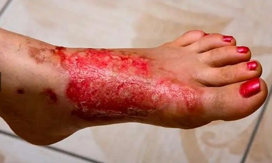 화상 범위가 넓고 심각한 화상