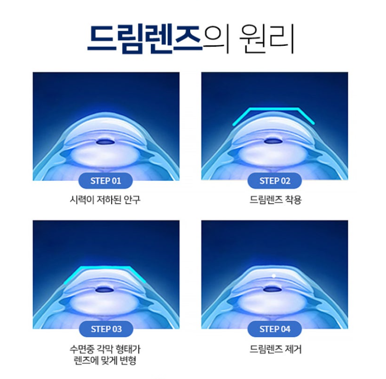 드림렌즈