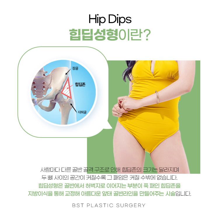 사람마다 다른 골반 골격 구조로 인해 힙딥존의 크기는 달라지며 두 뼈 사이의 공간이 커질수록 그 패임은 커질 수밖에 없습니다. 힙딥성형은 골반에서 허벅지로 이어지는 부분이 푹 패인 힙딥존을 지방이식을 통해 교정해 아름다운 앞태 골반라인을 만들어주는 시술입니다.