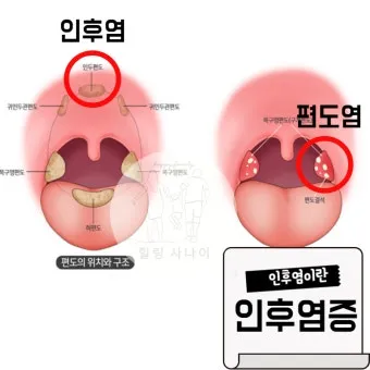 침 삼킬때 목아픔 코로나 증상인지 감별법_7