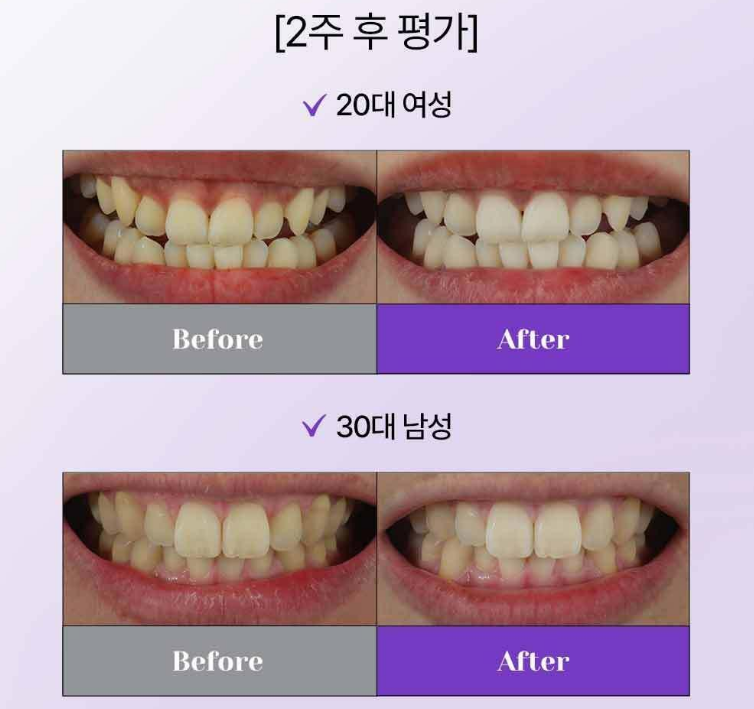 유시몰 치약,유시몰 치약 후기,유시몰 치약 화이트닝 효과,유시몰 치약 부작용,유시몰 치약 성분