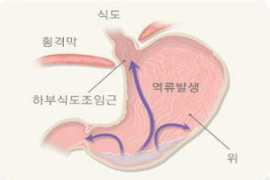 역류성 식도염 이미지 1