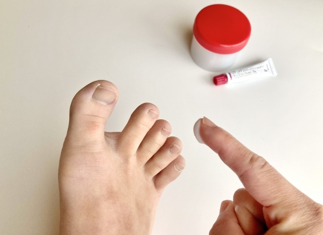 무좀-걸린부위에-약을-바르는 모습