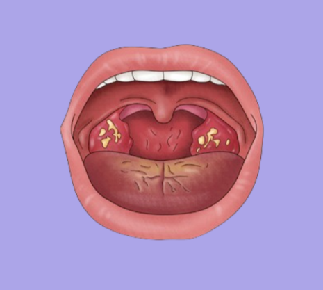 편도결석의 원인