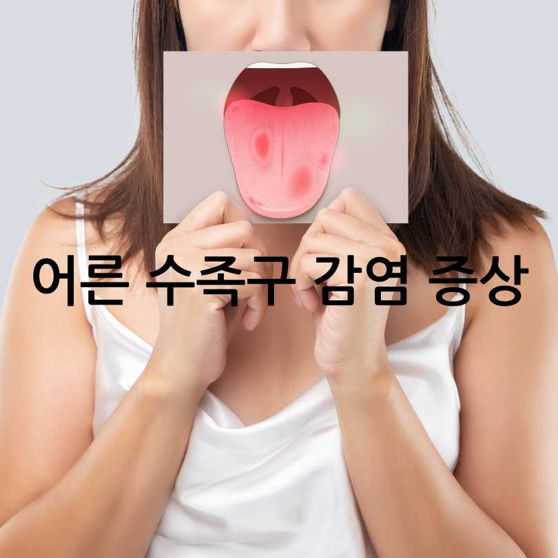 성인수족구 감염&amp;#44; 증상&amp;#44;원인&amp;#44; 경험담까지