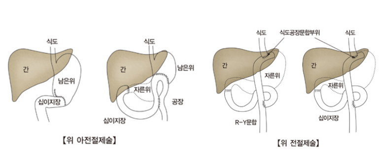 위절제술