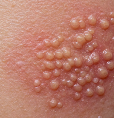 대상포진과 단순포진 차이 총정리 (바이러스, 면역력, 통증)