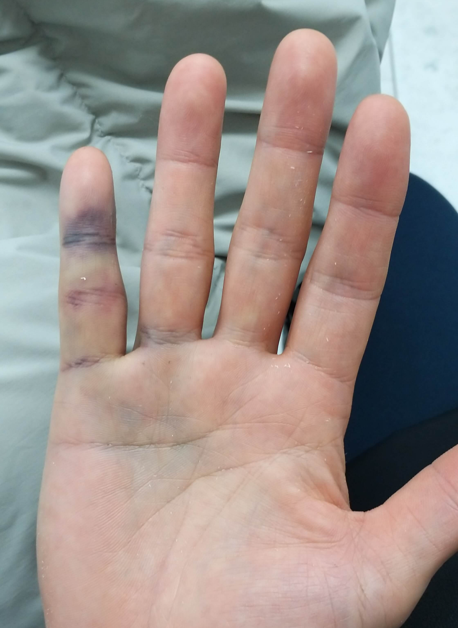처음병원간날손가락사진1