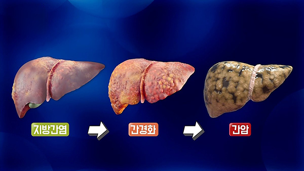 지방간이 간암으로 진행되는 과정을 나타낸 그림