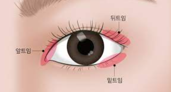 눈 성형 종류