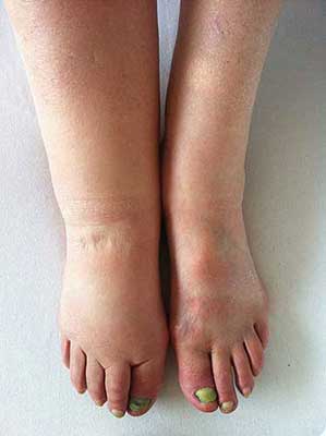 다리 부종의 원인