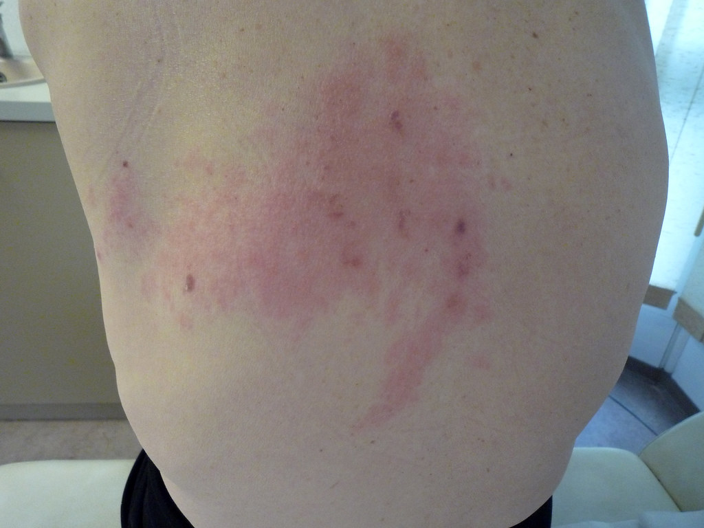 대상포진 초기증상