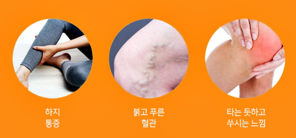 하지정맥류